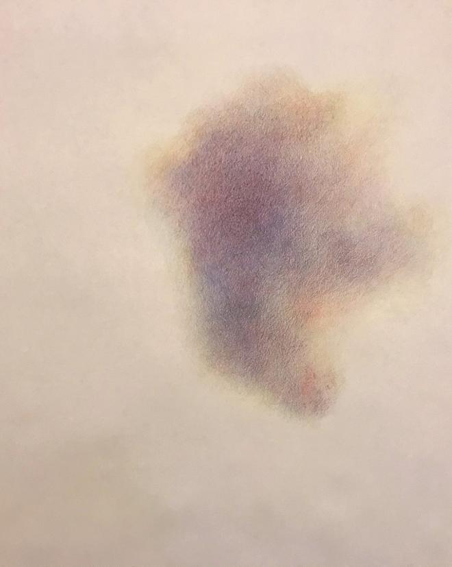A drawing of a bruise Painting